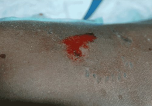 The Serious Consequences of Dog Bites on Muscles