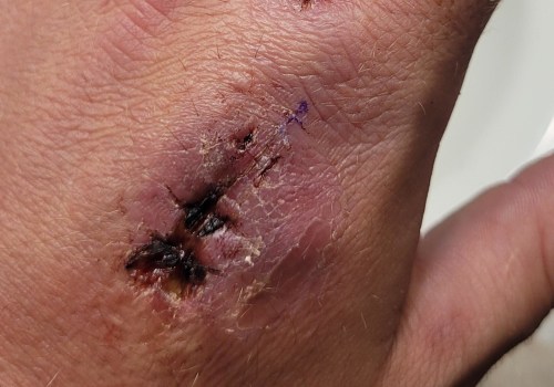 What to Do If a Dog Bites You and Draws Blood?